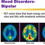 Bipolar Mood Disorder