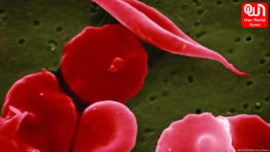 sickle cell disease