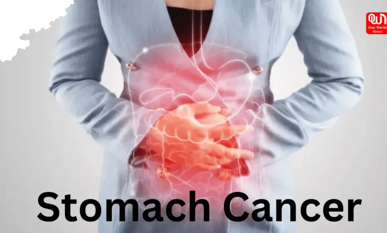 Stomach Cancer