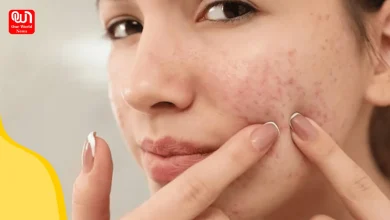 Struggling with acne