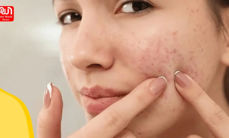 Struggling with acne