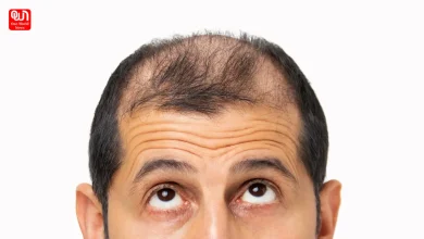 men hair loss