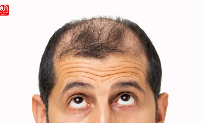 men hair loss