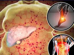 Liver Disease, Bloated Stomach