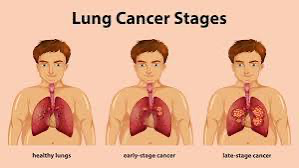 lung cancer