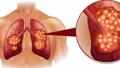 black mucus, lung cancer