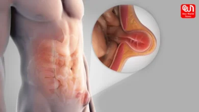 Hernia