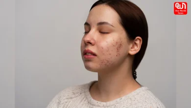 Skin Purging, Healthy Skin