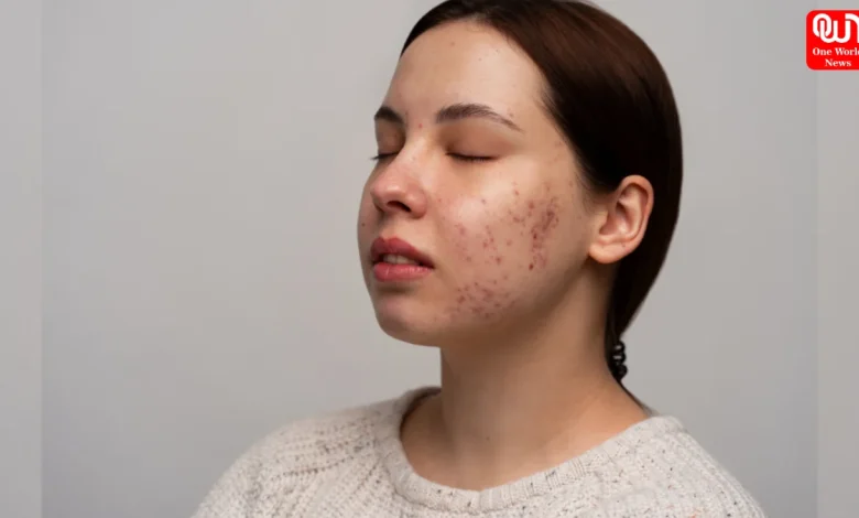 Skin Purging, Healthy Skin