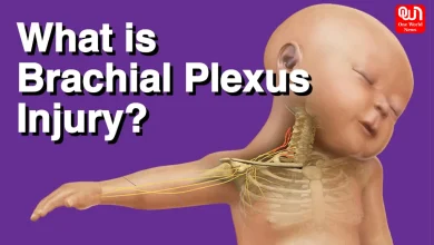 Brachial Plexus Birth Injuries